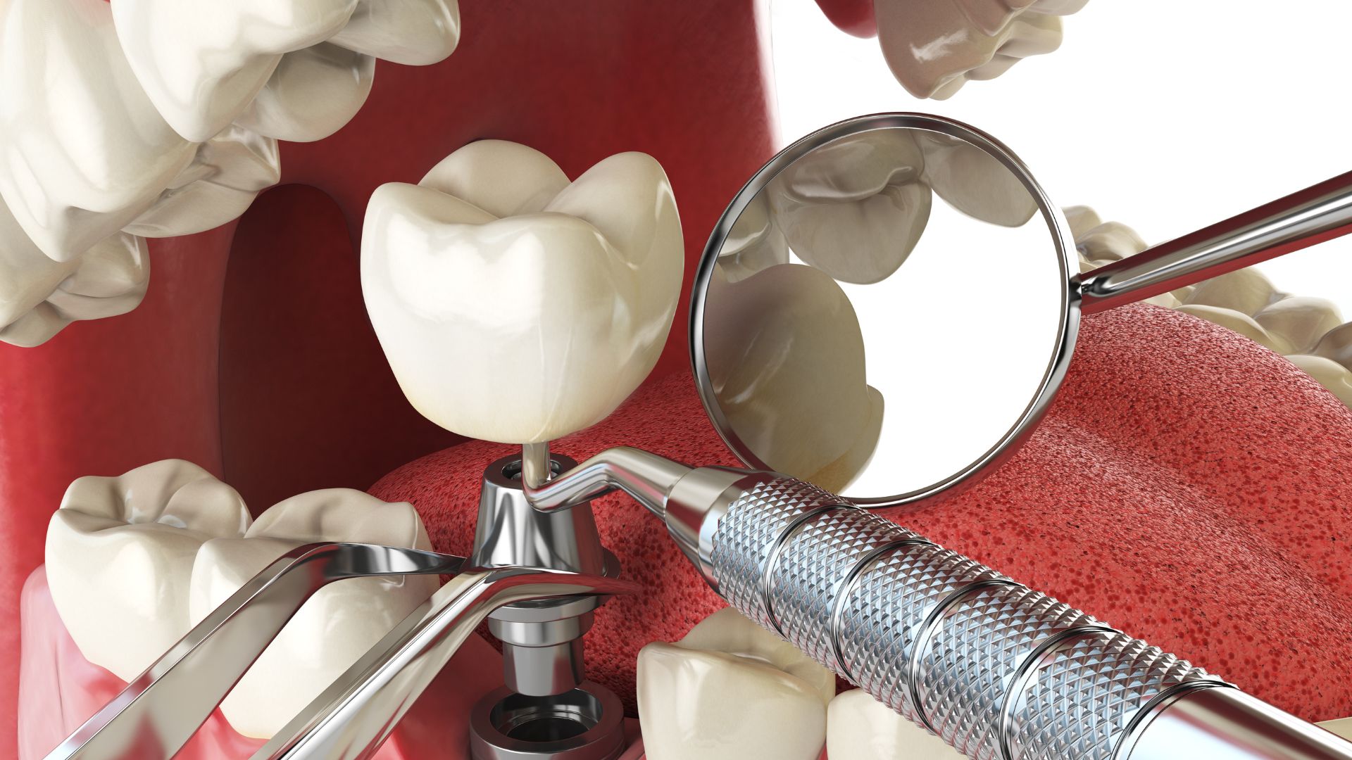 What Is a Dental Implant and Who Needs It?
